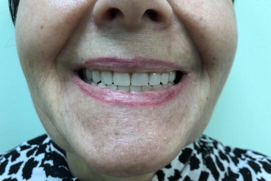 Кейс №2 - Протезирование верхней и нижней челюсти по технологии All-on-4/6