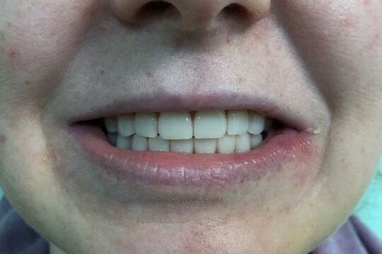 Кейс №1 - Установка несъемных протезов на обе челюсти за 5 дней