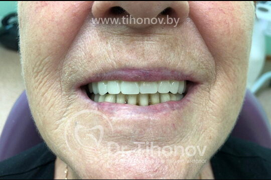 Кейс №5 - Установка 6 имплантов и несъемного протеза за 4 дня